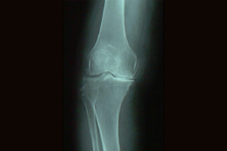 変形性膝関節症のX線写真